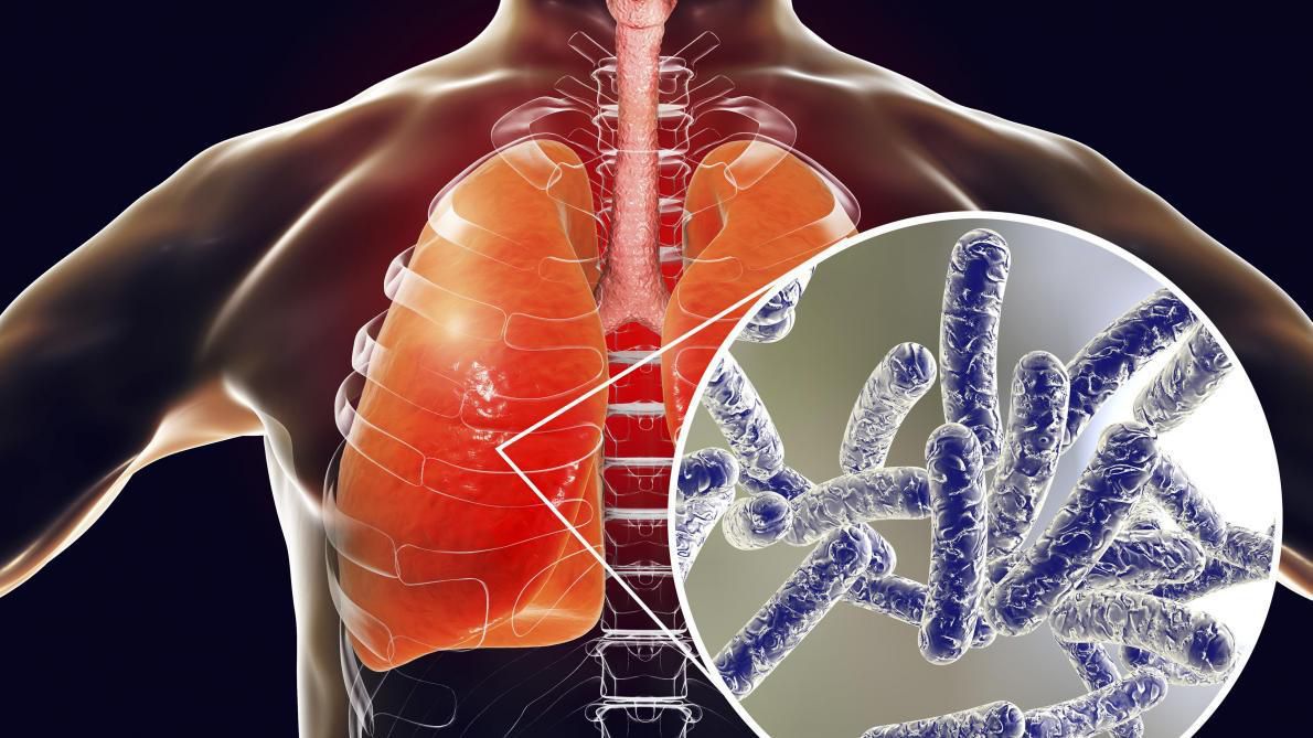 За рік на Черкащині виявили понад 480 випадків захворювання на туберкульоз