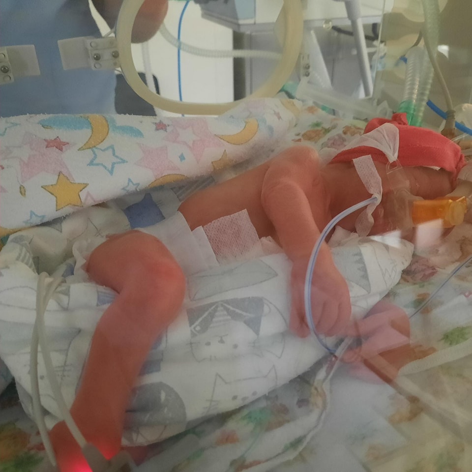У Черкаському перинатальному центрі медики виходили малюка, який народився з вагою 980 грамів